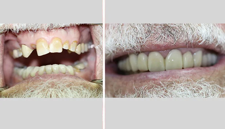 Case 1: before and after