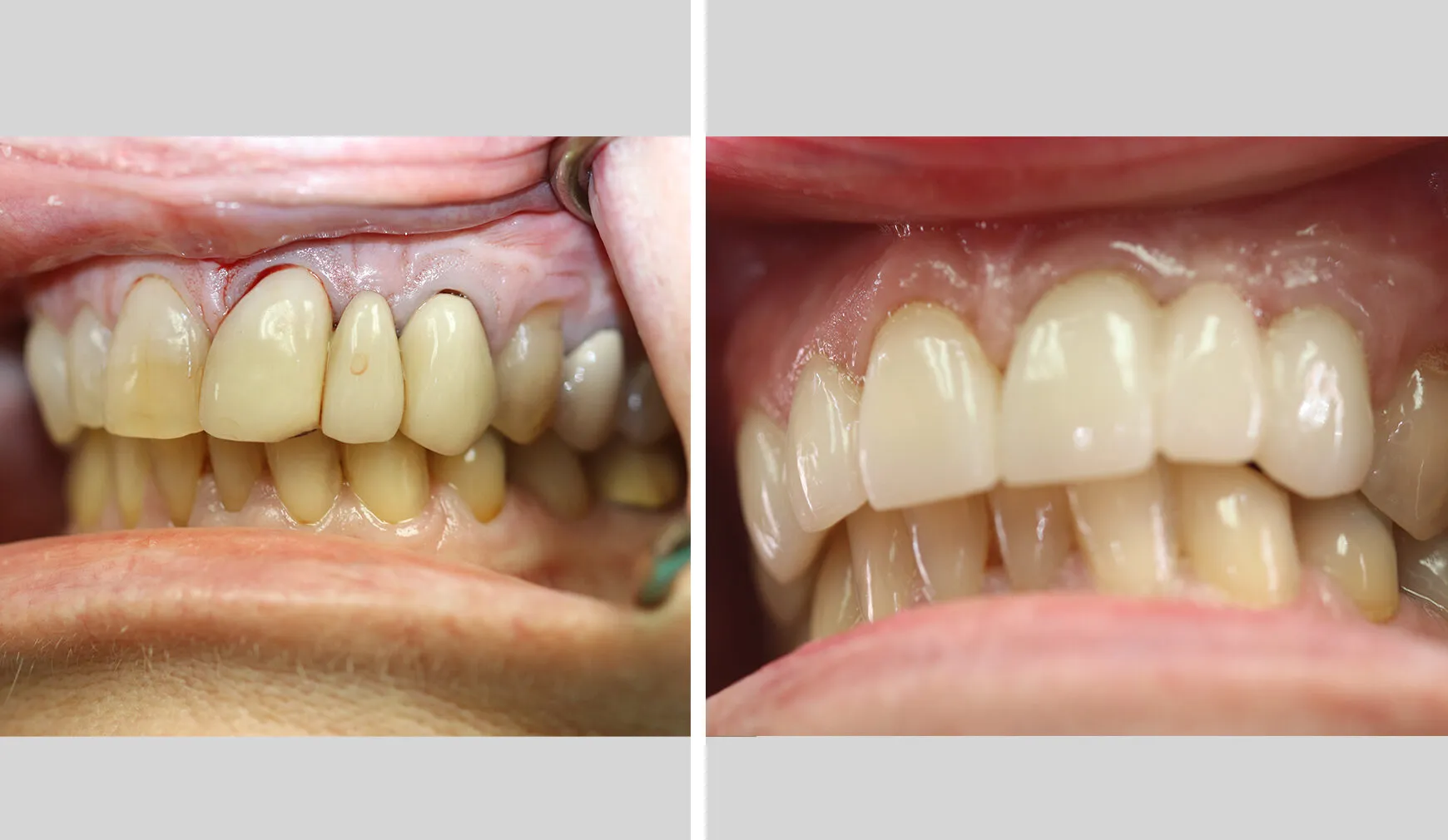 Case 3: before and after