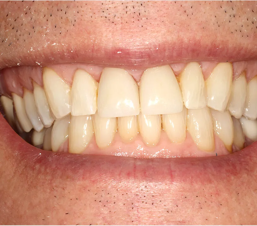 Case 1 After