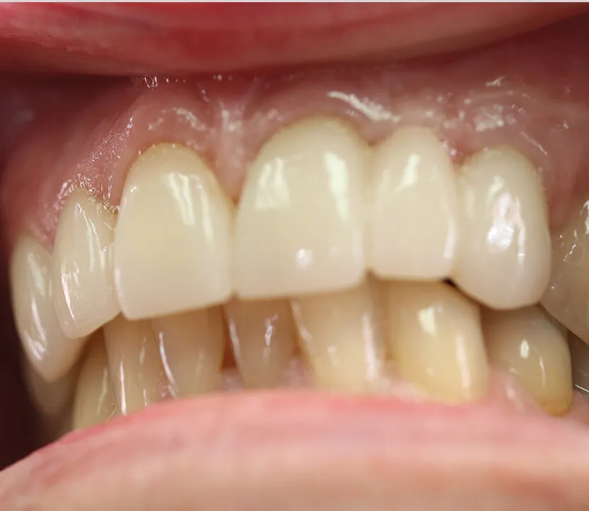 Case 4 After