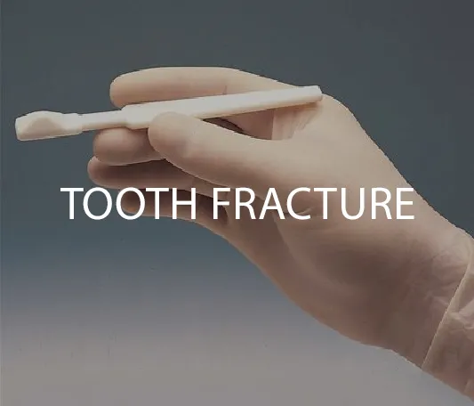 Tooth fracture