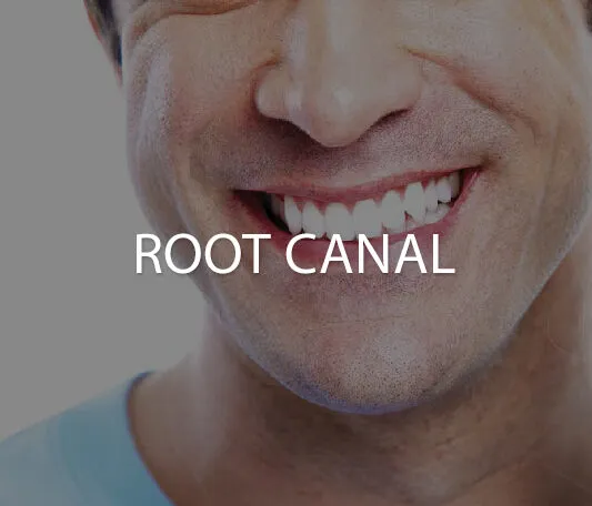 Root canal